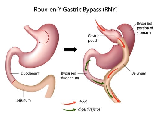 Gastric Bypass Reversal Roux-en-Y