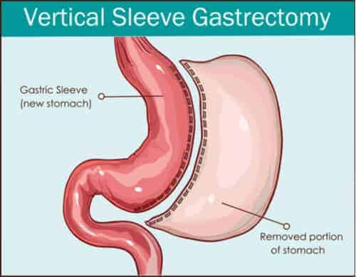 How Does Gastric Sleeve Work