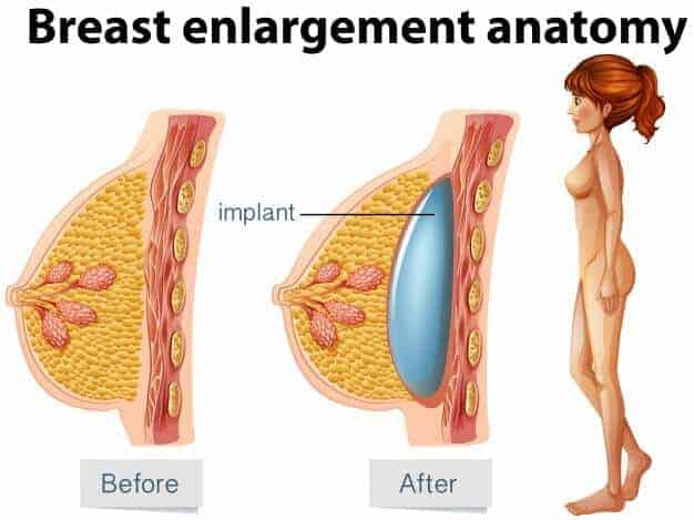 Breast Implant Enlargement in Before and After