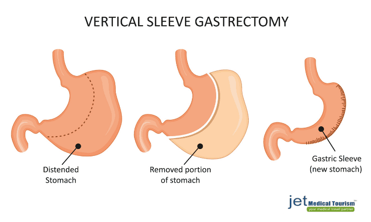 vertical sleeve gastrectomy in Mexico
