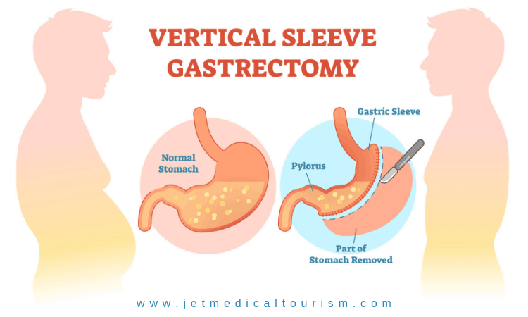 vertical sleeve gastrectomy