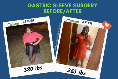 Dalatte gastric sleeve before after