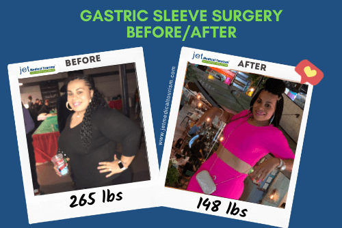 Christina gastric sleeve before after