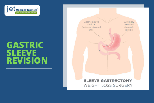 Gastric Sleeve Revision