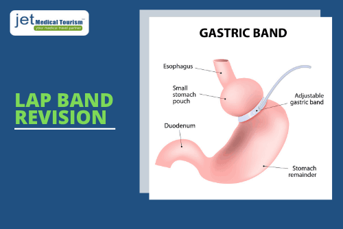Gastric Lap Band Revision