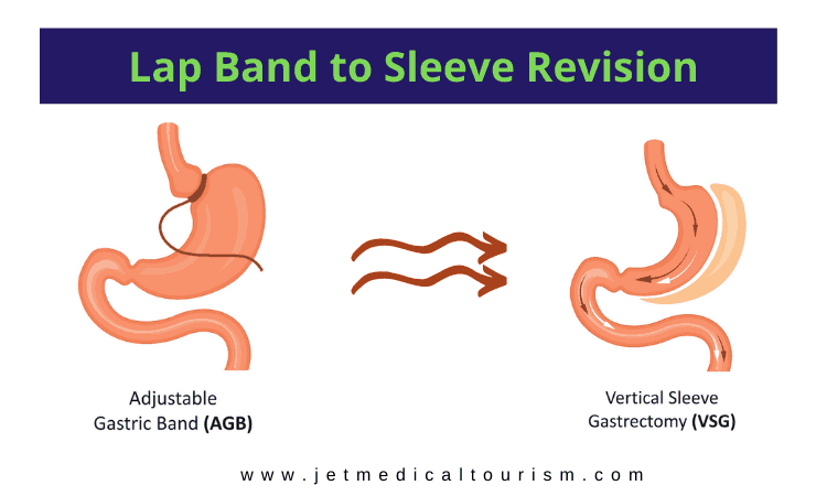 Lap Band to Sleeve Revision