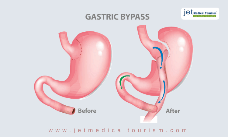 Gastric Bypass Mexico