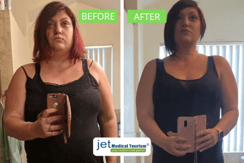 Gastric Sleeve Mexico Before & After