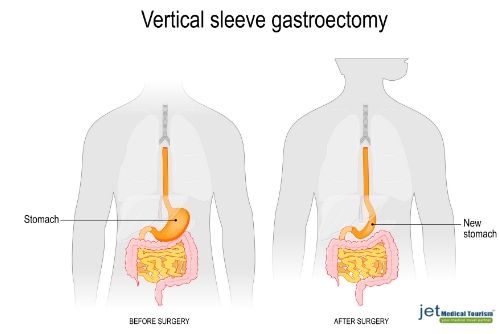 Mexico Gastric Sleeve Reviews