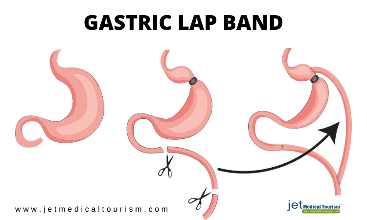 Gastric Lap Band Removal Mexico