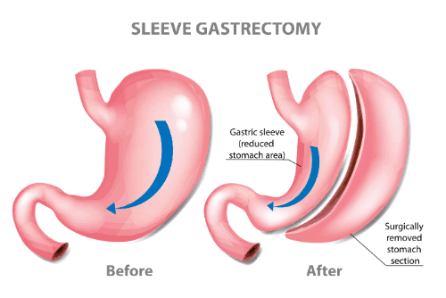 Gastric Sleeve Surgery Mexico
