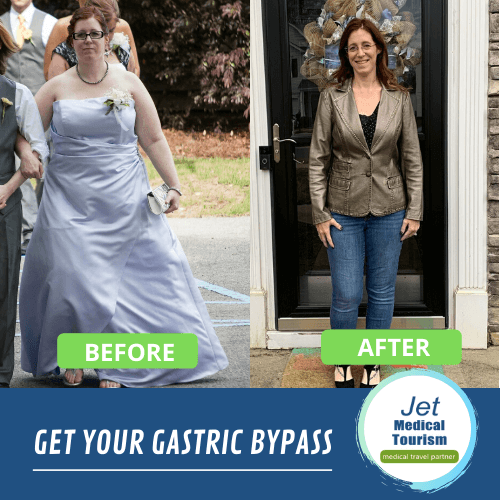 Gastric bypass before and after pictures
