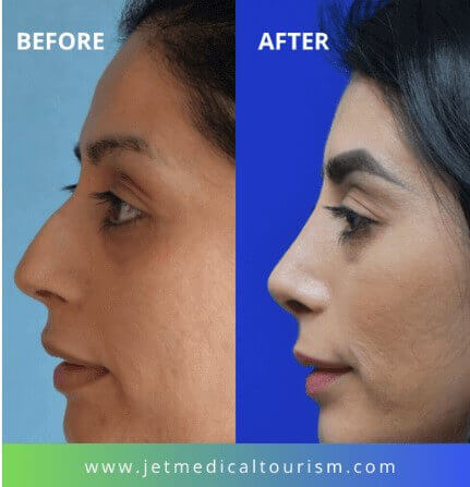 Mexico Nose Job Before and After
