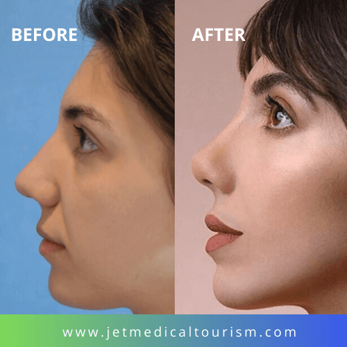 Mexico Rhinoplasty Before and After 