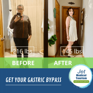 gastric bypass before and after picture female