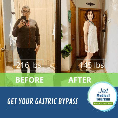 Gastric bypass before and after