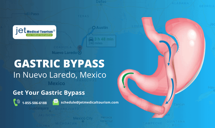 Gastric Bypass Nuevo Laredo Mexico
