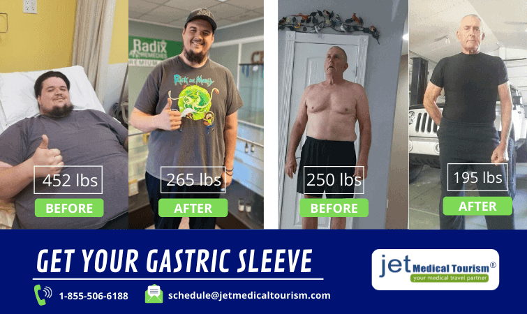 Gastric Sleeve Before and After Male