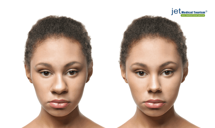 African American wide nose rhinoplasty