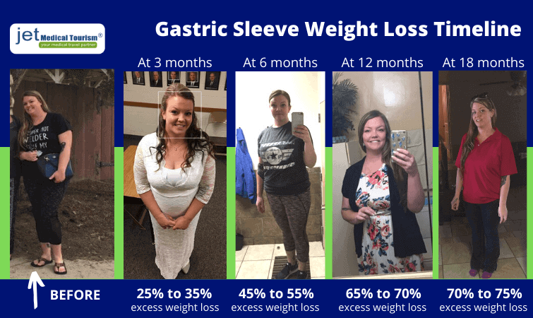 Gastric Sleeve Weight Loss Timeline