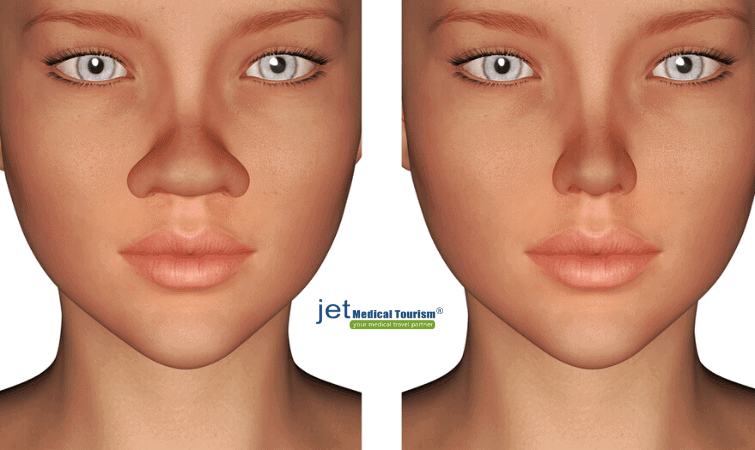 Rhinoplasty for Wide Nose