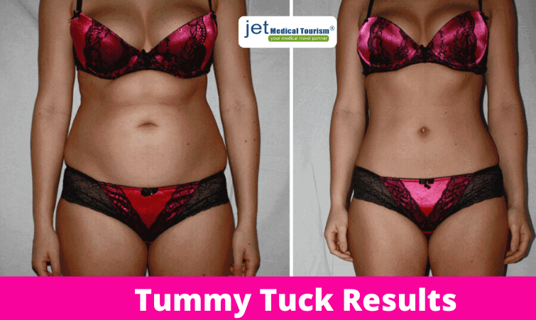 Tummy Tuck Results