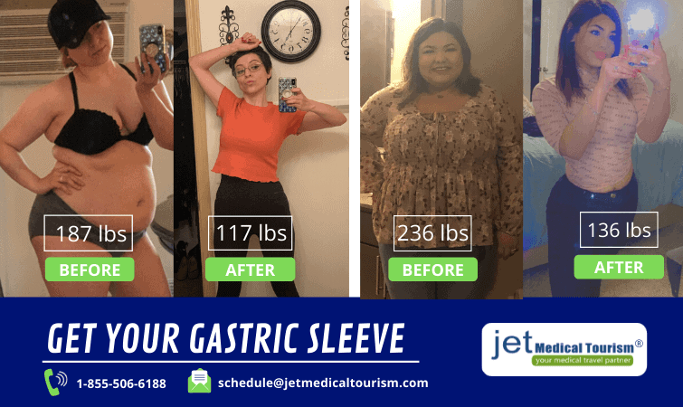 Gastric Sleeve Recovery Time: What to Expect?
