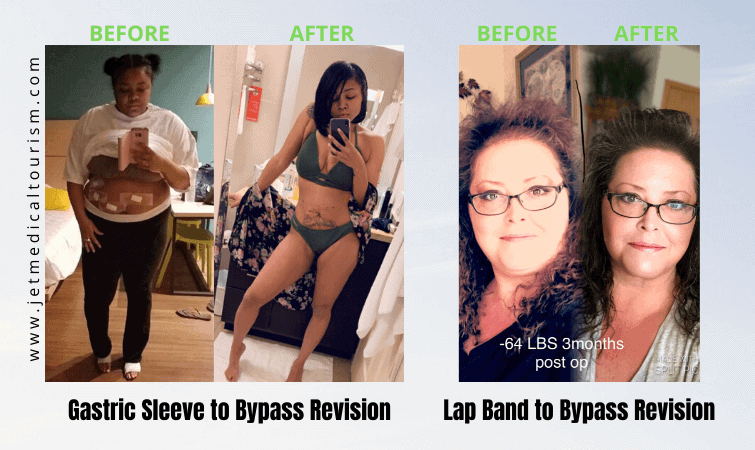 Gastric Bypass Revision Before and After