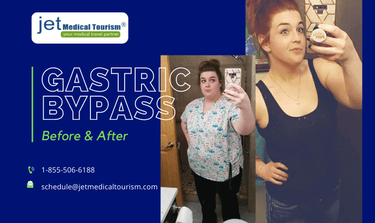 Gastric bypass surgery before after