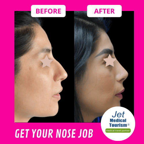 Nose Job Before and After Pic
