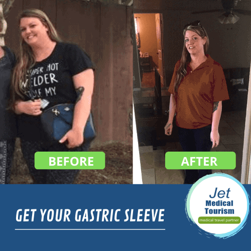 Female Gastric Sleeve Before and After