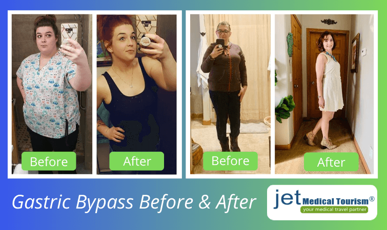 Gastric bypass before and before pictures