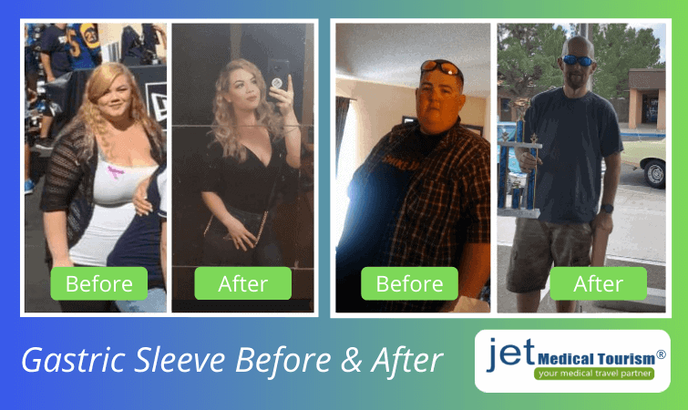Gastric sleeve before and after pictures