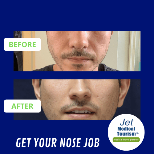 Nose Job Before and After Male