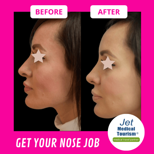 Nose Job before and After Photos