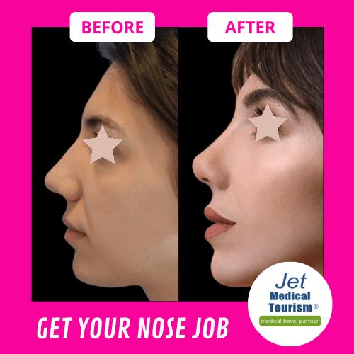 Nose Job Before and After Female