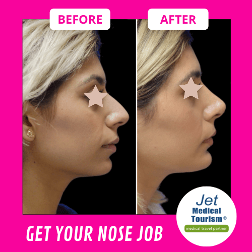 Rhinoplasty Before and After Women