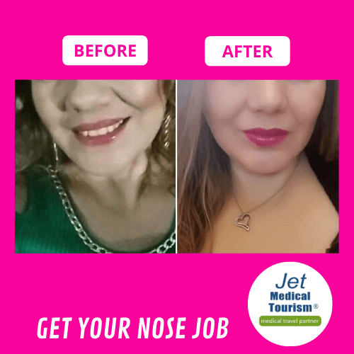 Wide Nose Job Before and After Female