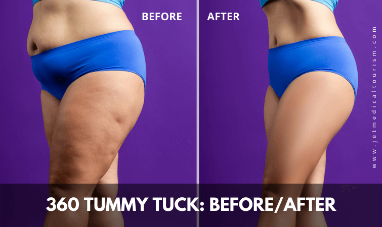 360 tummy tuck before and after