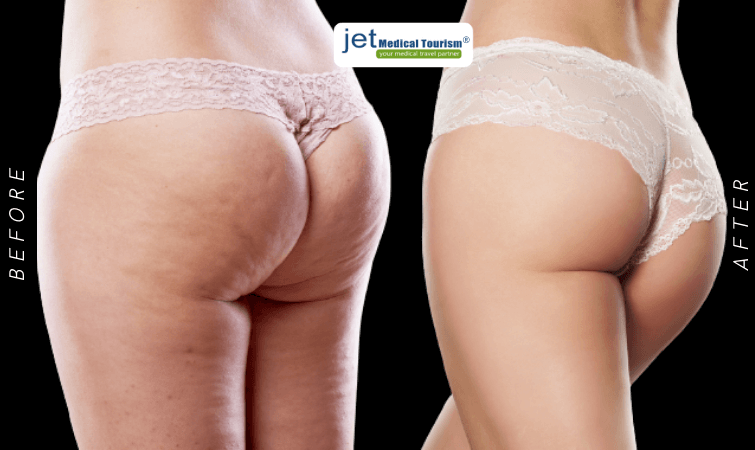 Brazilian Butt lift in Mexico - Affordable BBL Cost & Clinic