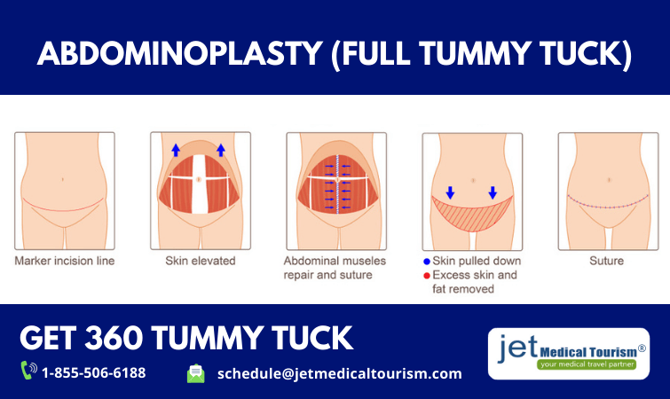 Weiler Plastic Surgery - Abdominoplasty or Tummy Tuck is one of the most  popular cosmetic procedures. It combines 360 liposuction, muscle plication,  and skin removal. This procedure results in that perfect slim