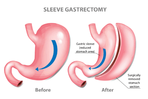 Role of ghrelin in gastric sleeve weight loss