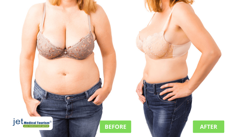 Gastric sleeve revision before and after