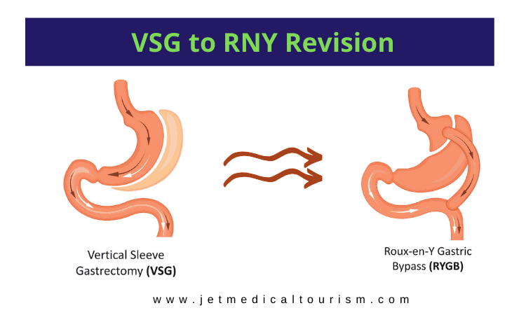 Vertical sleeve revision to gastric bypass