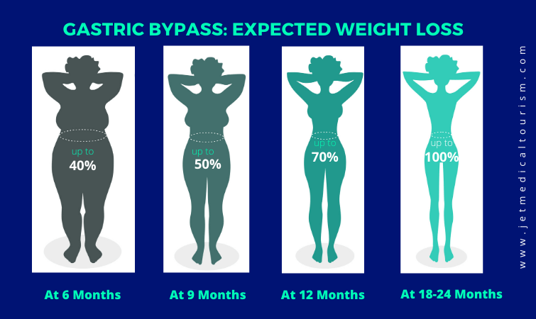 Expected weight loss after gastric bypass surgery