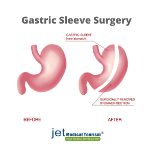 Gastric Sleeve and Pregnancy