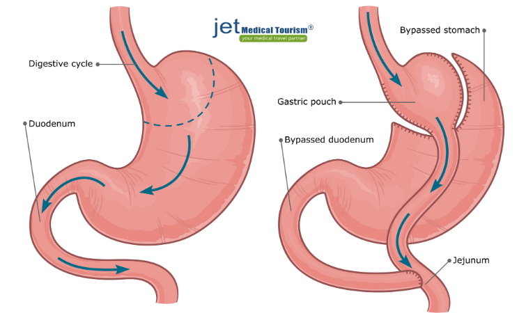 Pregnancy after gastric bypass