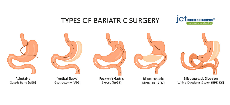 Bariatric Surgery for Treating Obesity
