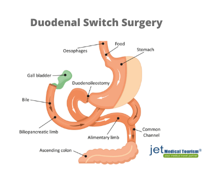 What is duodenal switch surgery?