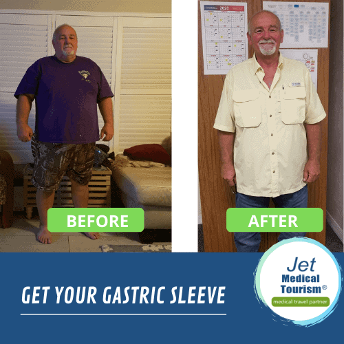 male gastric sleeve before and after picture